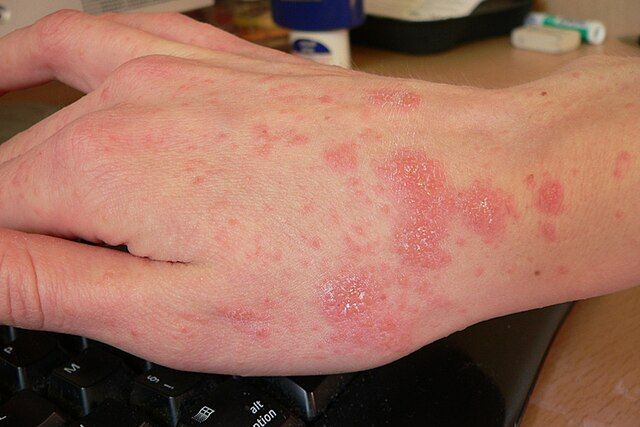 Sarna Noruega: 20 contagiados en hospital de Antofagasta