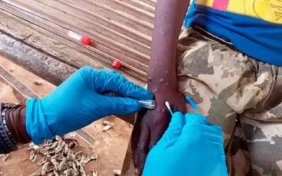 mpox