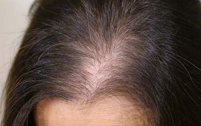 alopecia femenina